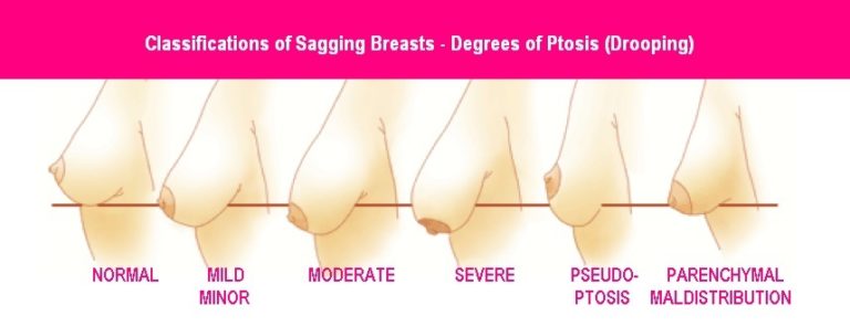 sagging ptosis droopy breastfeeding nipples augmentation different mastopexy implant ptotic drooping stages meaning empty cocorubyplasticsurgery triptomotherhood