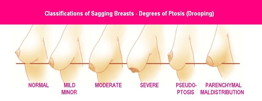 types-of-sagging-breasts